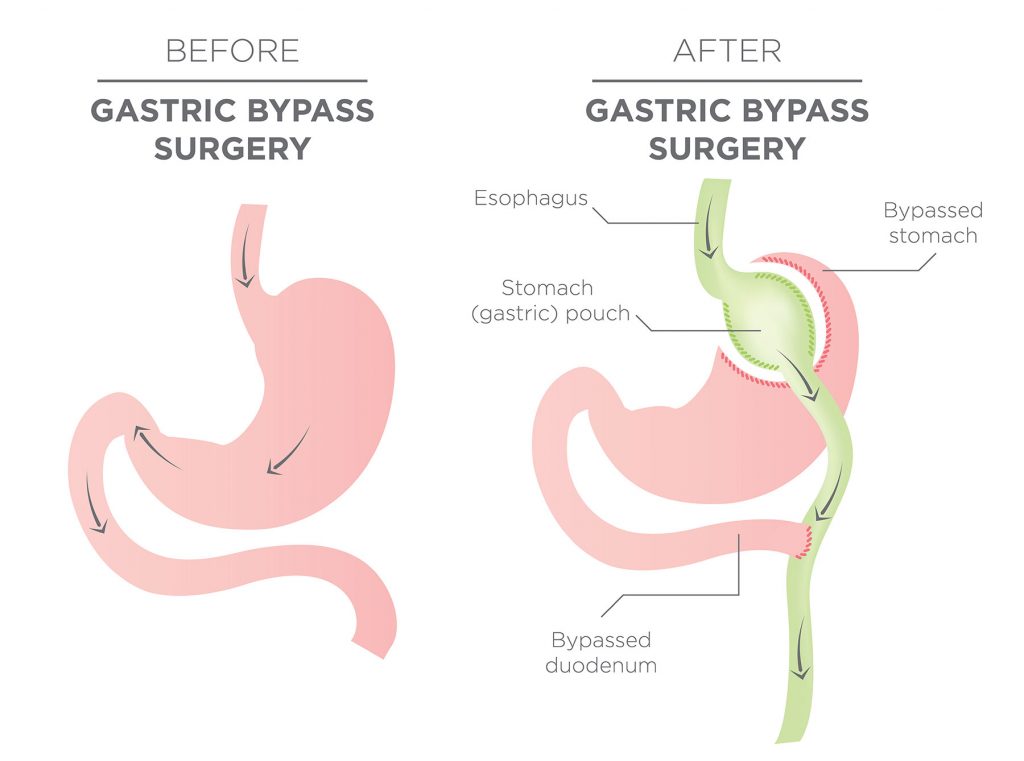 Before Gastric Bypass Surgery vs After Gastric Bypass Surgery Before Gastric Bypass Surgery vs After Gastric Bypass Surgery