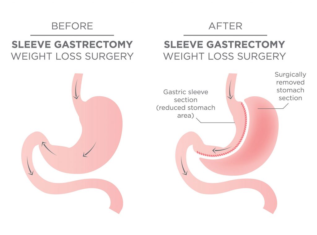 Before Sleeve Gastrectomy Weight Loss Surgery vs After Sleeve Gastrectomy Weight Loss Surgery Before Sleeve Gastrectomy Weight Loss Surgery vs After Sleeve Gastrectomy Weight Loss Surgery